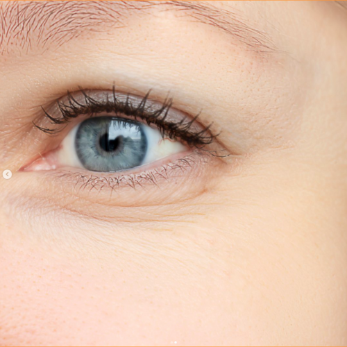 Toxina botulínica en Terrassa para arrugas de expresión